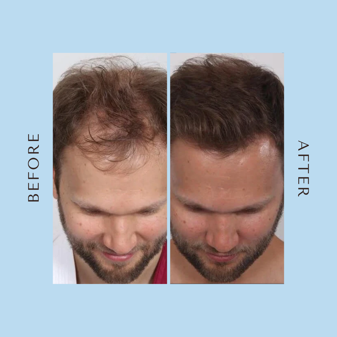 Advanced Hair Growth Roll-On Serum