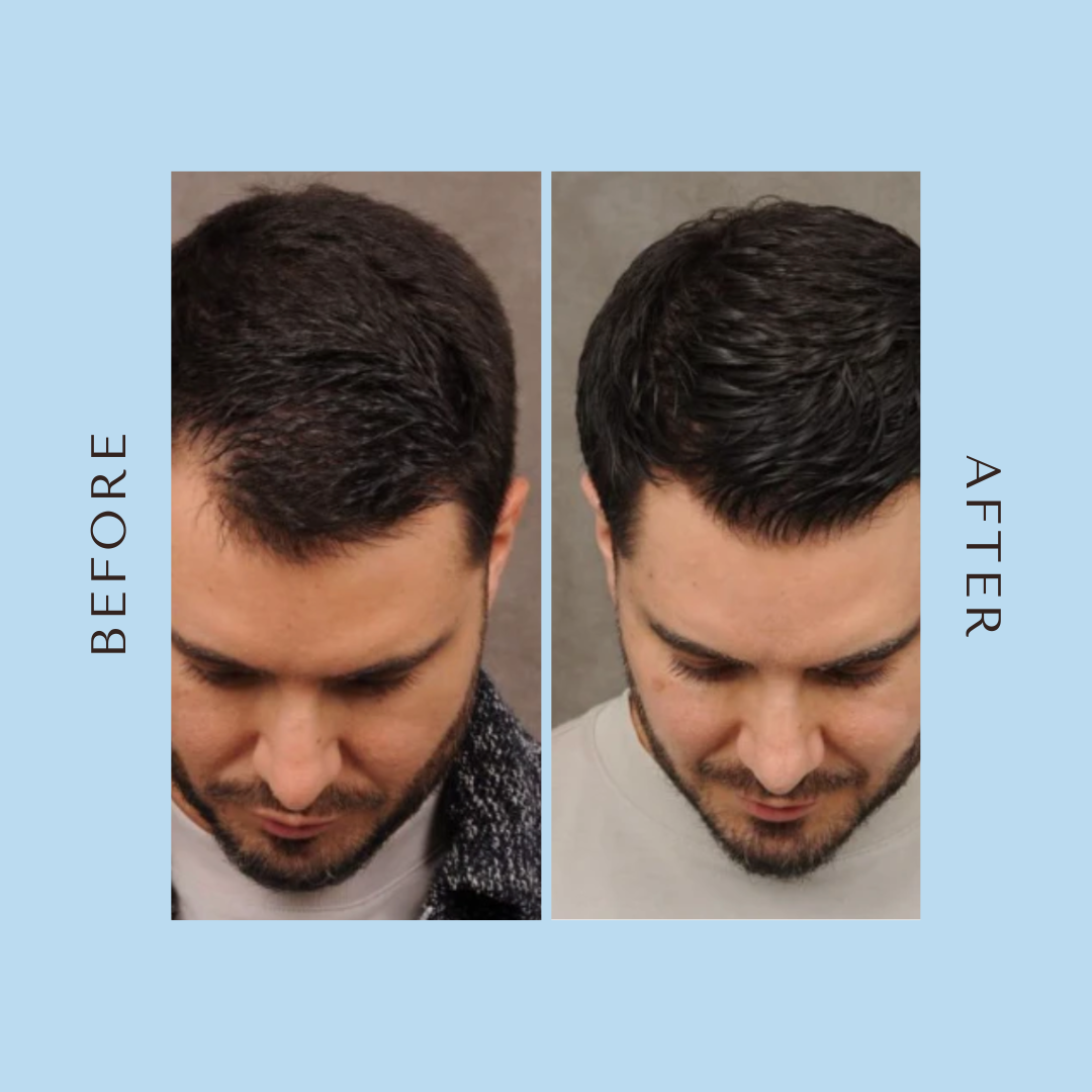 Advanced Hair Growth Roll-On Serum