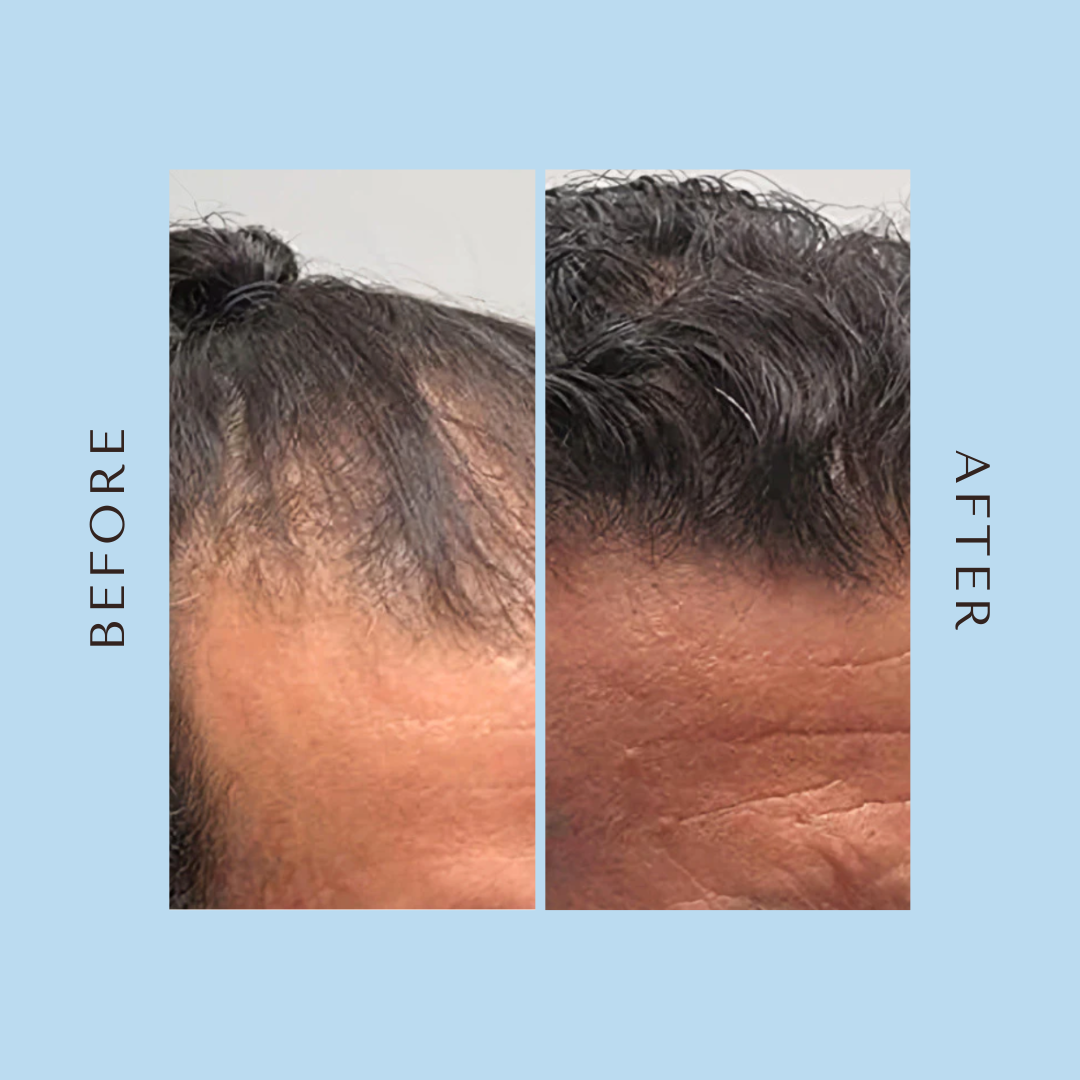 Advanced Hair Growth Roll-On Serum
